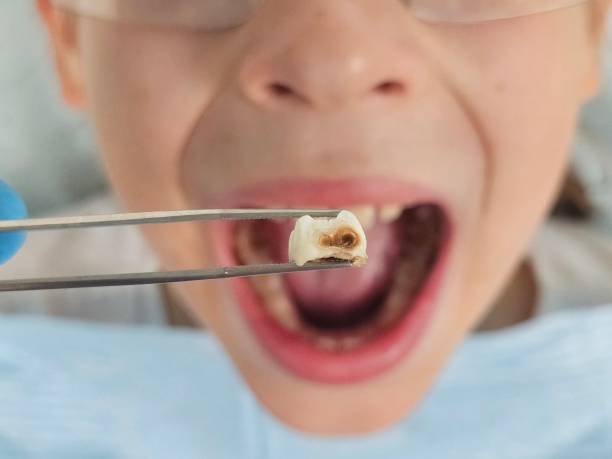Best Emergency Treatment for Oral Infections in Leisure World, MD